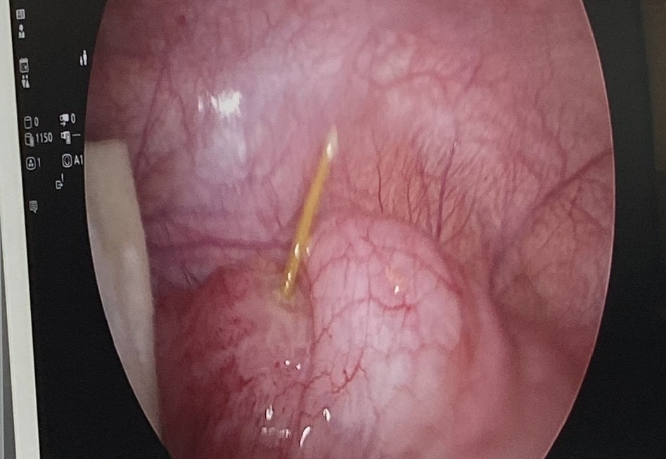 Phẫu thuật bệnh nhân nuốt cây tăm tre vào bụng đâm thủng manh tràng